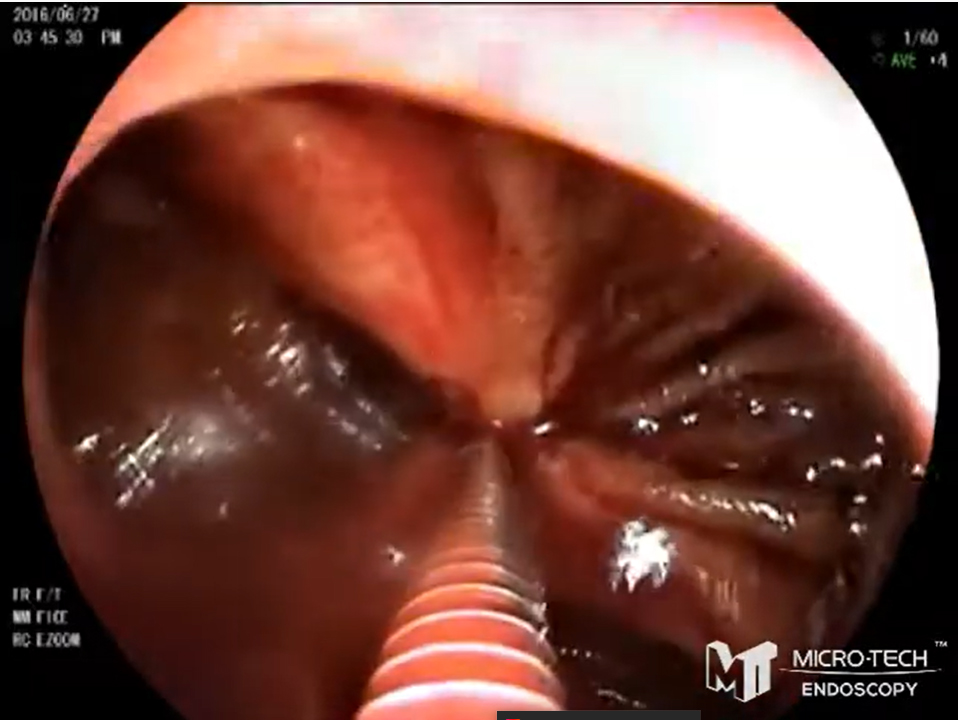 Introducing the new LOCKADO Clip from Micro-Tech Endoscopy